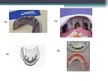 Konspekts 'Izņemamās zobu protēzes balstītas, uz implantiem', 40.