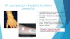 Prezentācija 'Alerģija pret lateksu', 6.