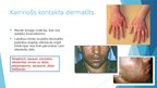 Prezentācija 'Alerģija pret lateksu', 8.