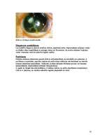 Referāts 'Redzes funkciju īpatnības dažādu acs pataloģiju gadījumos', 16.