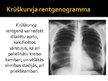 Prezentācija 'Aortas stenoze', 15.