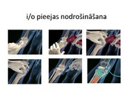 Prezentācija 'Intraosālā pieeja', 18.