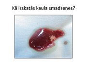 Prezentācija 'Intraosālā pieeja', 19.