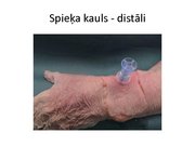 Prezentācija 'Intraosālā pieeja', 22.