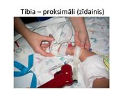 Prezentācija 'Intraosālā pieeja', 23.