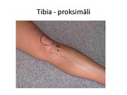 Prezentācija 'Intraosālā pieeja', 24.