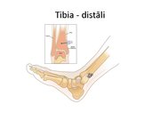 Prezentācija 'Intraosālā pieeja', 25.