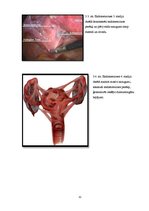 Referāts 'Sieviešu neauglības cēloņi un riska faktori', 32.
