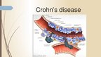 Prezentācija 'Crohn's Disease', 4.