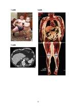 Referāts 'Taukaudu hormoni un aptaukošanās', 13.