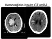 Prezentācija 'Akūti galvas smadzeņu asinsrites traucējumi', 8.