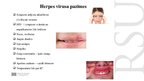 Prezentācija 'Kāpēc zobu higiēnistiem nekad nevajadzētu ārstēt pacientu ar aktīvu orālo herpes', 4.