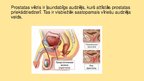 Prezentācija 'Prostatas vēzis', 3.