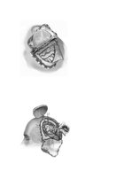 Referāts 'Neiroķirurģisko operāciju apraksti', 2.