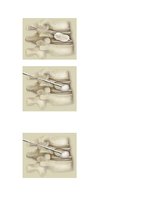 Referāts 'Neiroķirurģisko operāciju apraksti', 16.