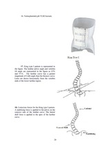 Referāts 'Korsete - palīglīdzeklis idioptiskās skoliozes ārstēšanai pusaudžu vecumā', 26.