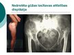 Prezentācija 'Gūžas locītavas attīstības displāzija', 27.