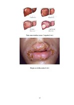 Referāts 'Seksuāli transmisīvās slimības', 17.