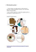 Eseja 'Neirofibromatoze', 4.