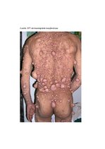 Eseja 'Neirofibromatoze', 5.