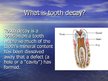 Prezentācija 'Tooth Decay', 2.