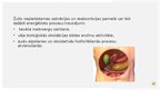 Prezentācija 'Aknu pamatfunkciju traucējumi: Žults veidošanās un izdales traucējumi', 13.