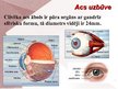 Prezentācija 'Cilvēka acu un redzes slimības', 2.