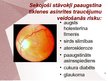 Prezentācija 'Cilvēka acu un redzes slimības', 4.