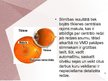 Prezentācija 'Cilvēka acu un redzes slimības', 6.