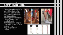 Prezentācija 'Ceļa hiperekstensija', 2.