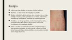 Prezentācija 'Ādas slimības', 5.