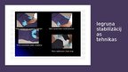 Prezentācija 'Iegurņa kaula lūzumi, iegurņa stabilizācijas tehnikas. Krūšu kurvja, krūšu kaula', 11.