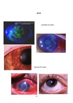 Referāts 'Vīrusu keratīti', 13.