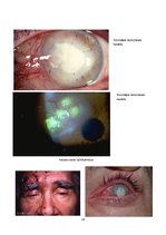 Referāts 'Vīrusu keratīti', 14.