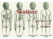 Prezentācija 'Skolioze', 1.