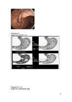 Referāts 'Kuņģa vēzis', 21.