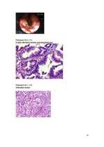 Referāts 'Kuņģa vēzis', 22.