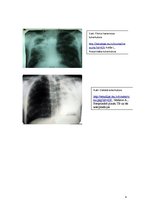 Konspekts 'Silikotuberkuloze', 4.