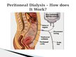 Prezentācija 'Peritoneal Dialysis', 4.