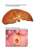 Referāts 'Pirmā tipa cukura diabēts', 16.