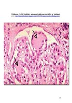 Referāts 'Pirmā tipa cukura diabēts', 19.