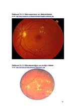 Referāts 'Pirmā tipa cukura diabēts', 20.