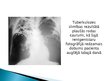 Prezentācija 'Tuberkuloze', 3.