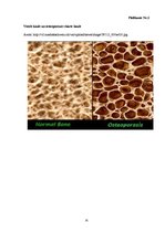 Referāts 'Kaulu lūzumi - viena no osteoporozes komplikācijām sievietēm pēc 45 gadiem', 35.