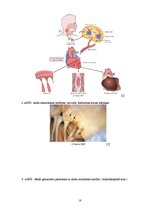 Referāts 'Reimatiskās sirdskaites', 18.