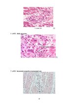 Referāts 'Reimatiskās sirdskaites', 19.