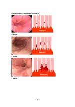 Referāts 'Gastroezofageāla refluksa slimība', 16.
