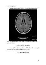 Referāts 'Magnētiskās rezonasnes izmeklējuma rezultāti dinamikā pacientiem ar multiplo skl', 20.