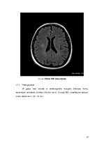 Referāts 'Magnētiskās rezonasnes izmeklējuma rezultāti dinamikā pacientiem ar multiplo skl', 25.