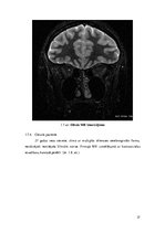 Referāts 'Magnētiskās rezonasnes izmeklējuma rezultāti dinamikā pacientiem ar multiplo skl', 27.
